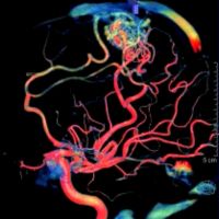 Exemplo de uma angiografia cerebral digital 4D, de uma MAV