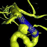 Reconstrução tridimensional na angiografia cerebral