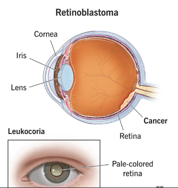 retinoblastoma