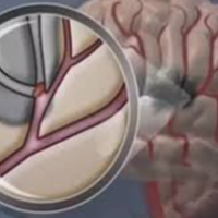 Hematoma Sub-Dural Crônico