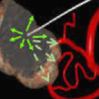 Meningioma