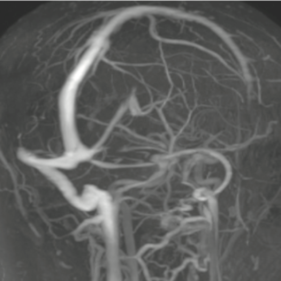 Hipertensão Intracraniana Idiopática/Pseudotumor