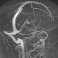 Hipertensão Intracraniana Idiopática/Pseudotumor