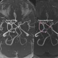 Síndrome de Vasoconstrição Cerebral Reversível