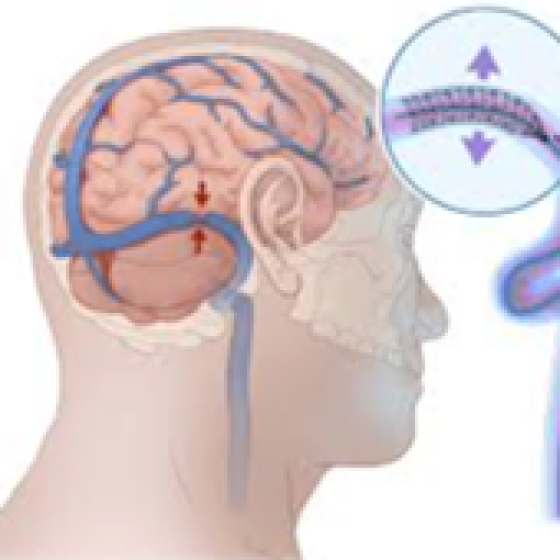 Hipertensão Idiopática Intracraniana