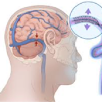 Hipertensão Idiopática Intracraniana