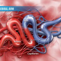 Fistula Arterio Venosa Dural Cerebral e Medular